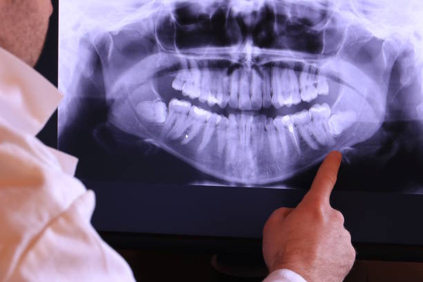 Best Emergency Dentist for Lost Fillings or Crowns in East Ridge, TN