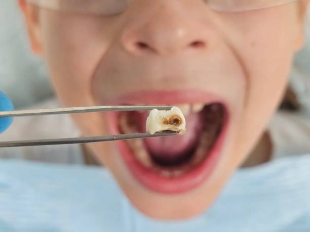 Best Emergency Dental Extractions in East Ridge, TN